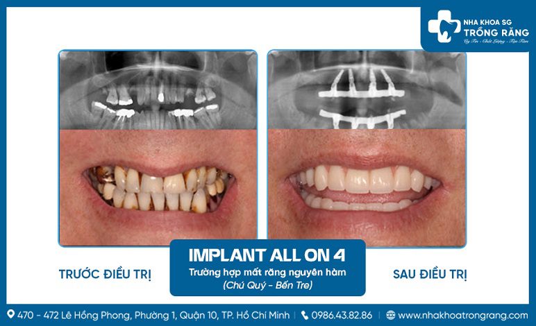 Cấy ghép răng hai hàm với implant all on 4