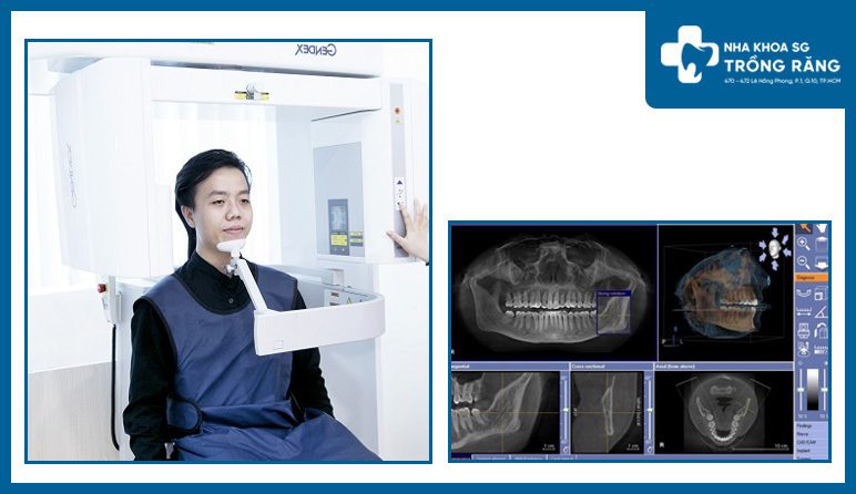 Chụp Ct 3D Conebeam để kiểm tra răng Implant