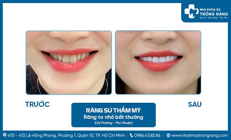 Co nen boc rang su khong Có nên bọc răng sứ không