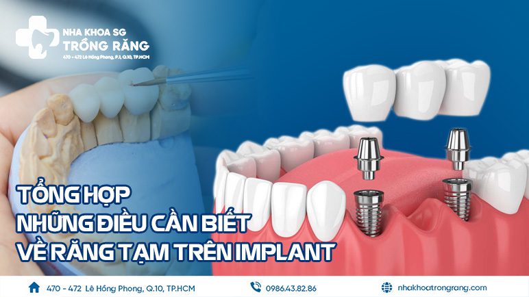 Rang tam tren implant Răng tạm trên implant