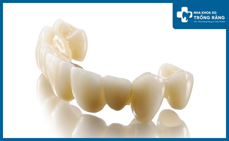 Rang toan su tren Implant Răng toàn sứ trên Implant