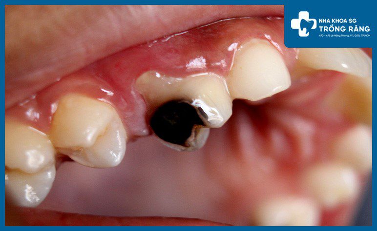 Sâu răng gây đau nhức vào ban đêm