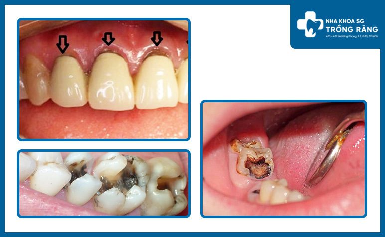Sâu răng là nguyên nhân bọc răng sứ bị hôi miệng