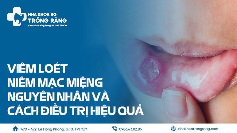 Viêm loét niêm mạc miệng làm sao hết