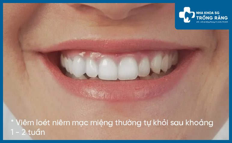 Viêm loét niêm mạc miệng sẽ tự khỏi