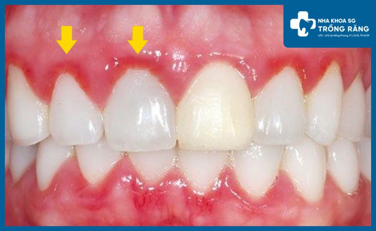 Viem nuou lam rang su bi hoi Viêm nướu làm răng sứ bị hôi