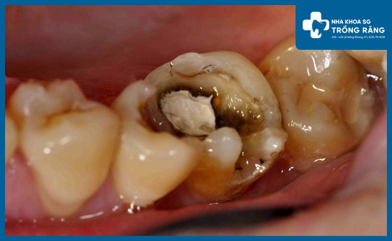 Viêm tủy răng gây đau nhức răng vào ban đêm