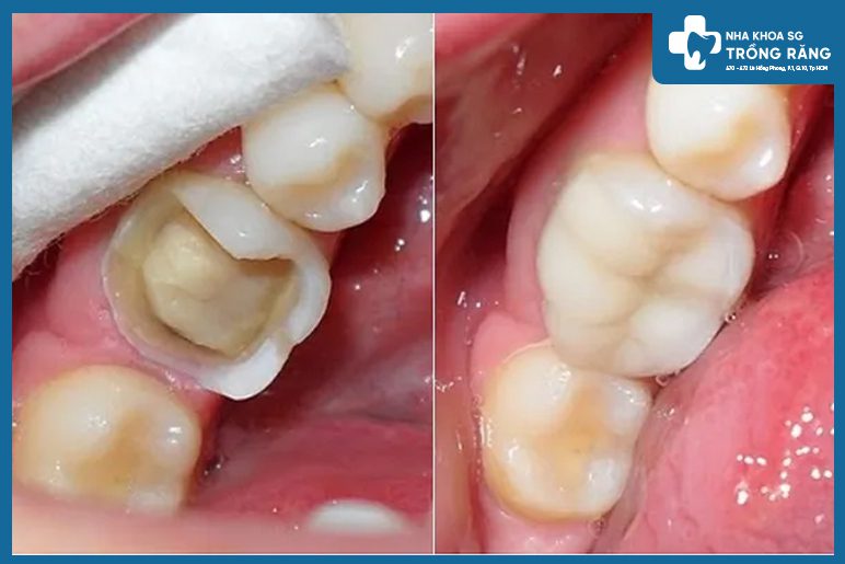 bọc sứ răng bị nứt