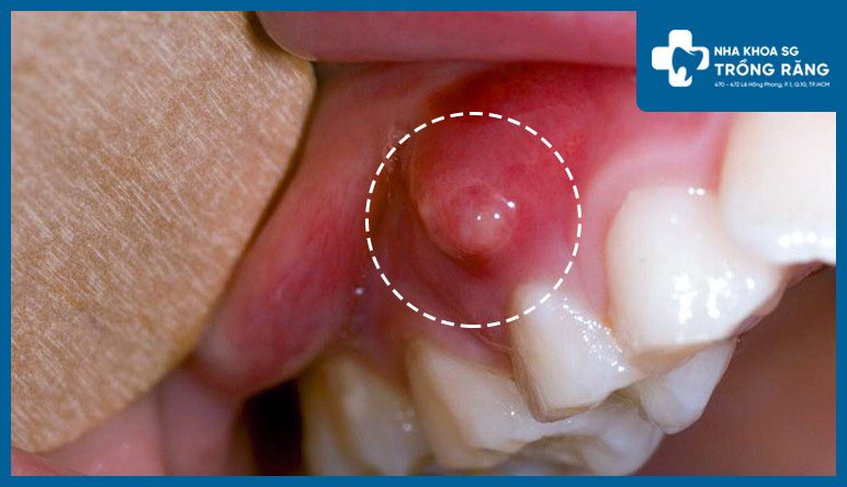 Nhức răng do nhiễm trùng áp xe