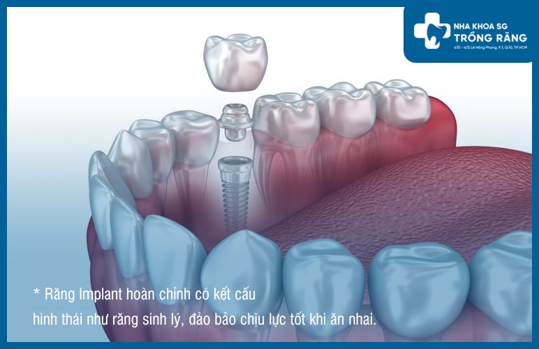 Trồng răng implant khi mất răng vĩnh viễn