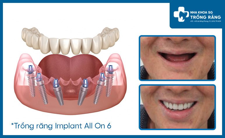 Trồng răng implant toàn hàm
