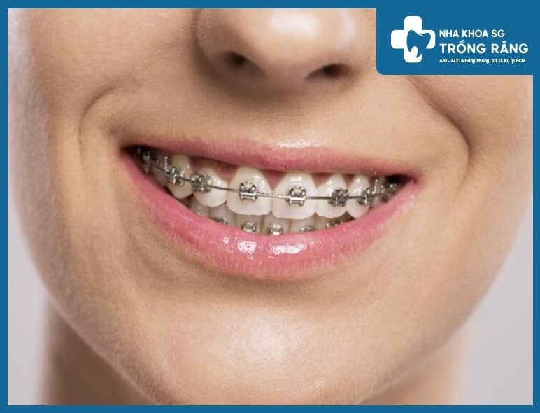 niềng răng bằng mắc cài kim loại niềng răng bằng mắc cài kim loại