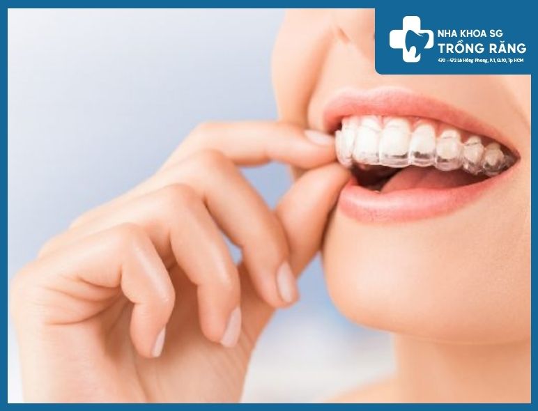 niềng răng không mắc cài niềng răng không mắc cài