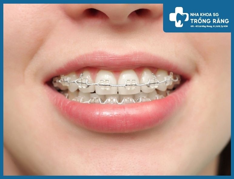 niềng răng bằng mắc cài sứ niềng răng bằng mắc cài sứ
