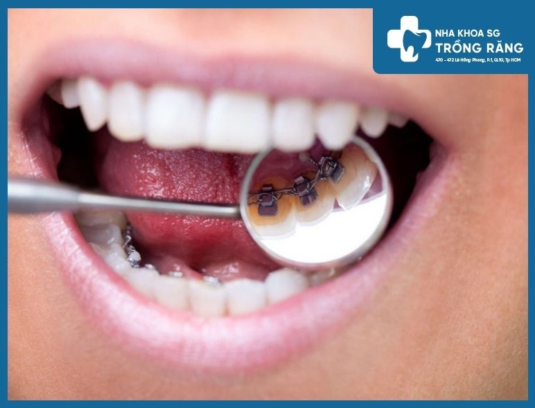 niềng răng mắc cài mặt lưỡi niềng răng mắc cài mặt lưỡi