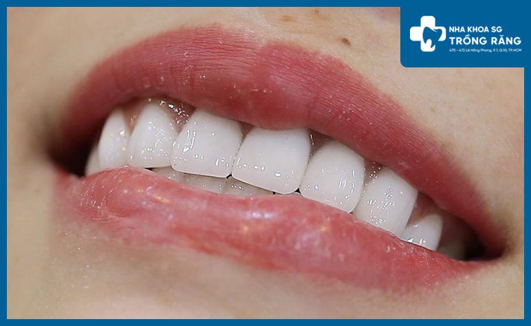 Tuổi thọ răng sứ Tuổi thọ răng sứ