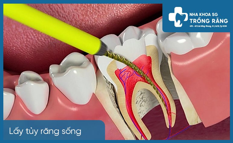 lấy tủy răng sống là như thế nào lấy tủy răng sống là như thế nào
