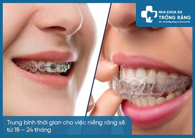 niềng răng mất bao lâu niềng răng mất bao lâu