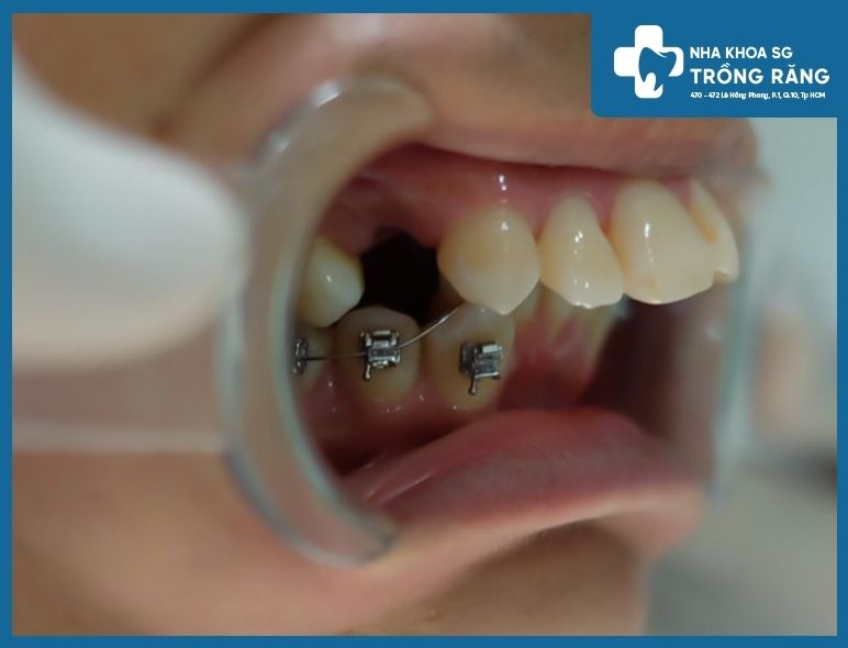 niềng răng nhổ răng số 4 niềng răng nhổ răng số 4
