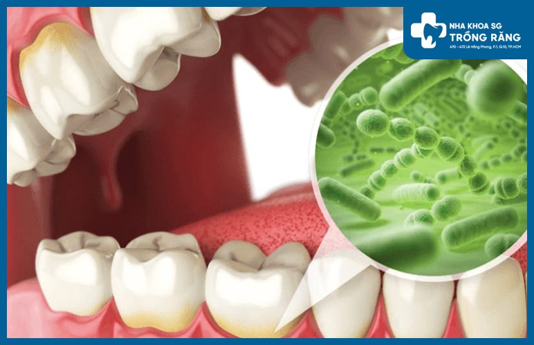 Đau răng do vi khuẩn tấn công