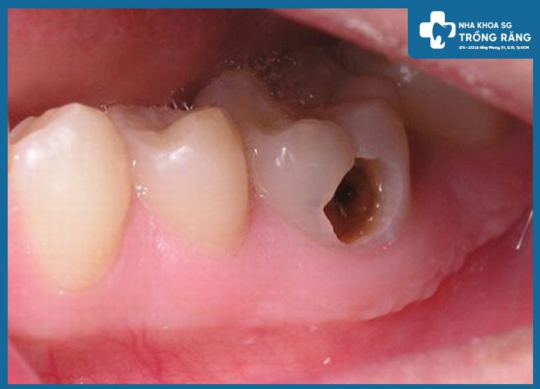 răng bị sâu viêm tủy