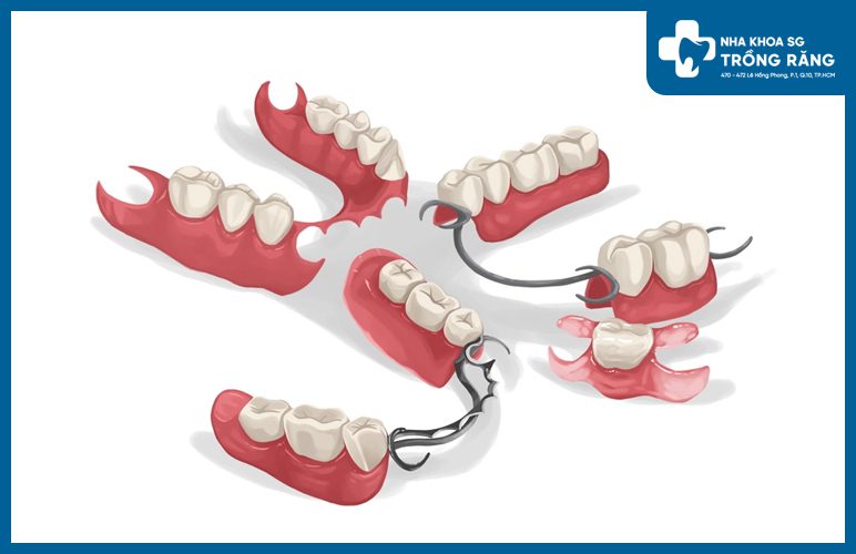Răng giả tháo lắp nhựa cứng bán phần răng giả tháo lắp nhựa cứng bán phần