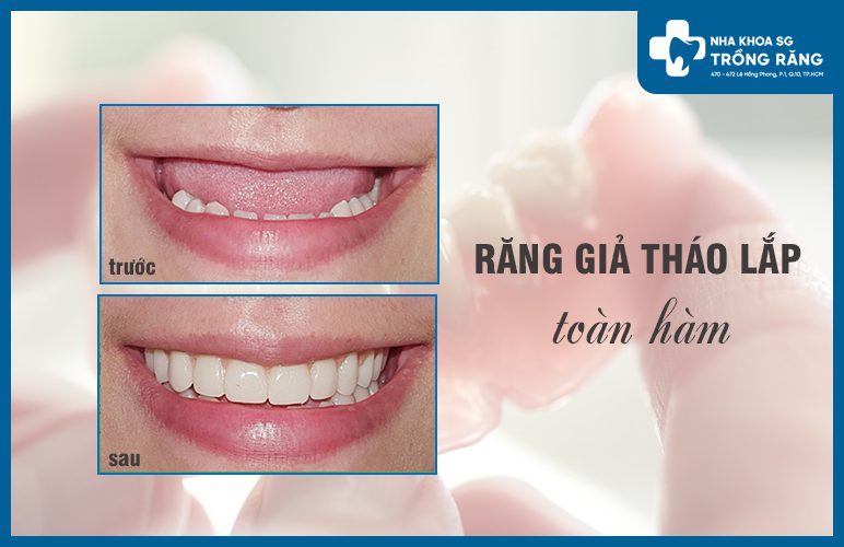 Răng giả tháo lắp nhựa cứng có tốt không răng giả tháo lắp nhựa cứng có tốt không