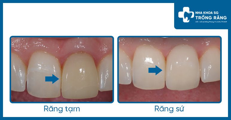 so sánh răng giả tạm thời và răng giả vĩnh viễn
