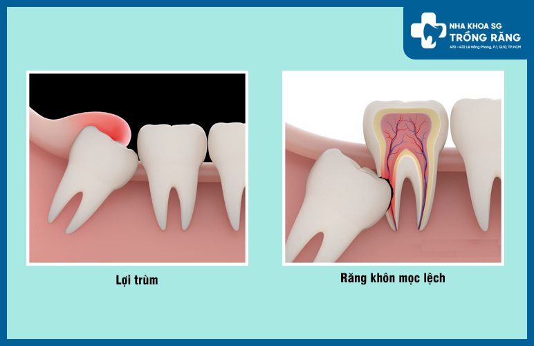 sưng nướu răng hàm trên do mọc răng khôn