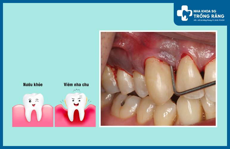 sưng nướu răng hàm trên do viêm nha chu