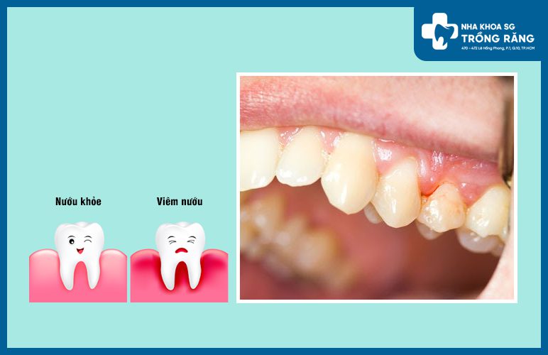 sưng nướu răng hàm trên do viêm nướu