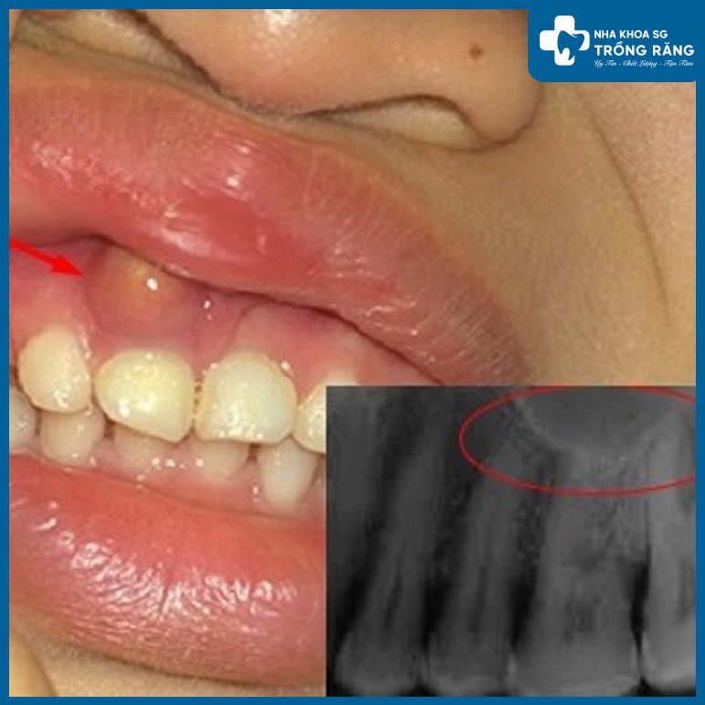 Biểu hiện của bệnh u răng