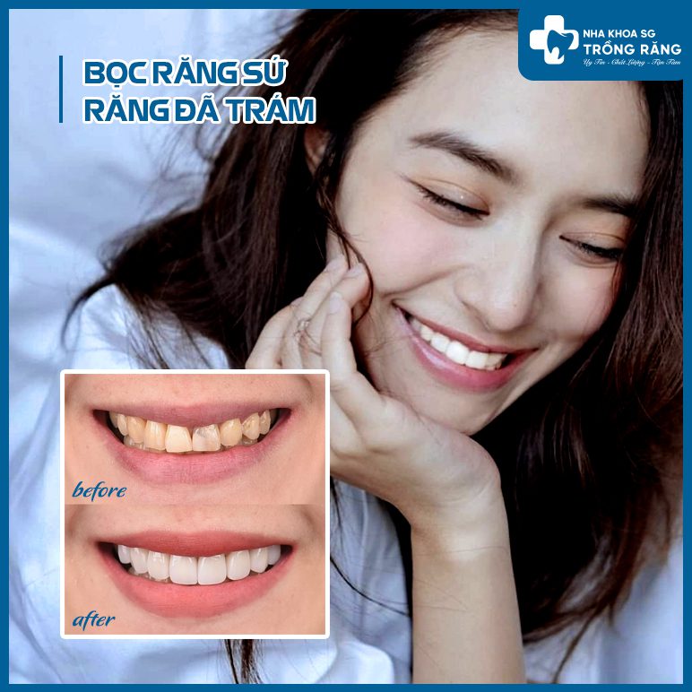 bọc sứ răng đã trám bọc sứ răng đã trám