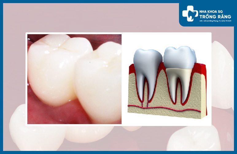 Bọc sứ răng số 7 bọc sứ răng số 7