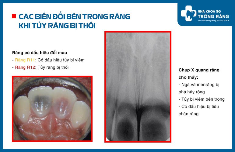 các biến đổi khi tủy răng bị thối các biến đổi khi tủy răng bị thối