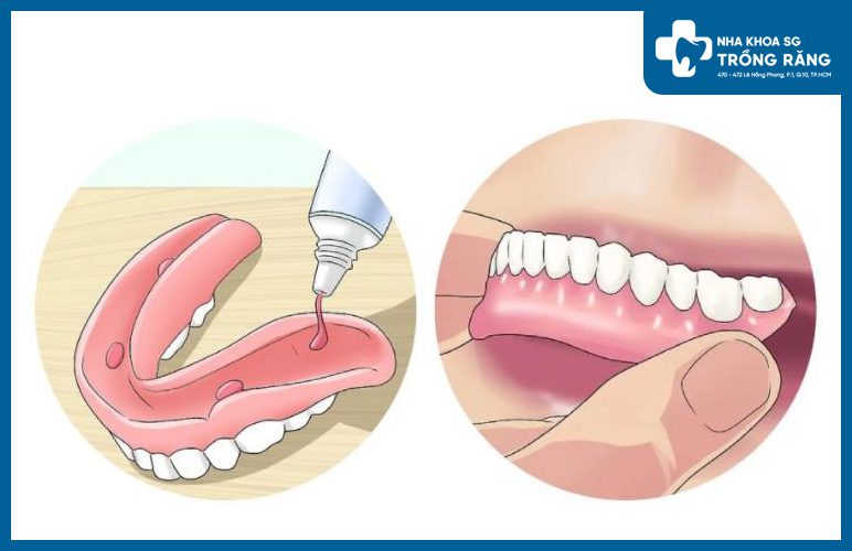 dán hàm răng giả dán hàm răng giả