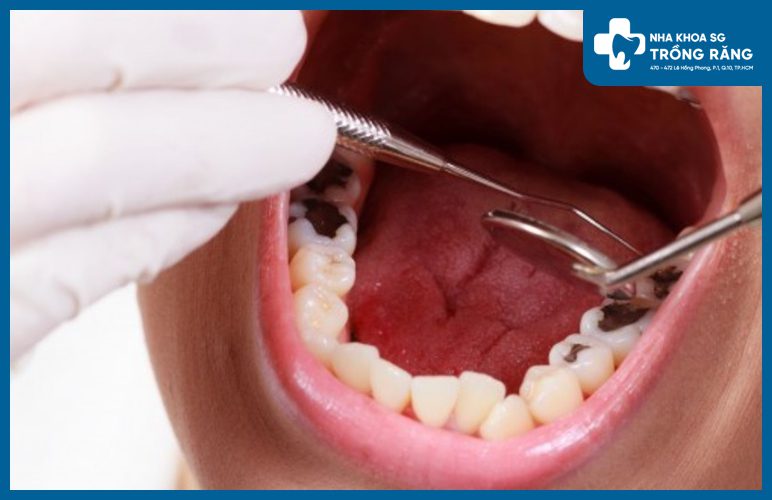 đau răng số 7 do sâu răng đau răng số 7 do sâu răng