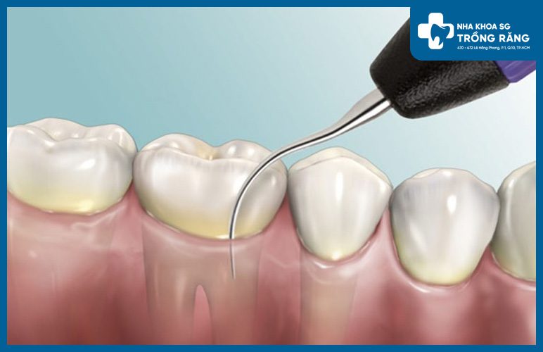 Điều trị viêm nha chu răng số 7 điều trị viêm nha chu răng số 7