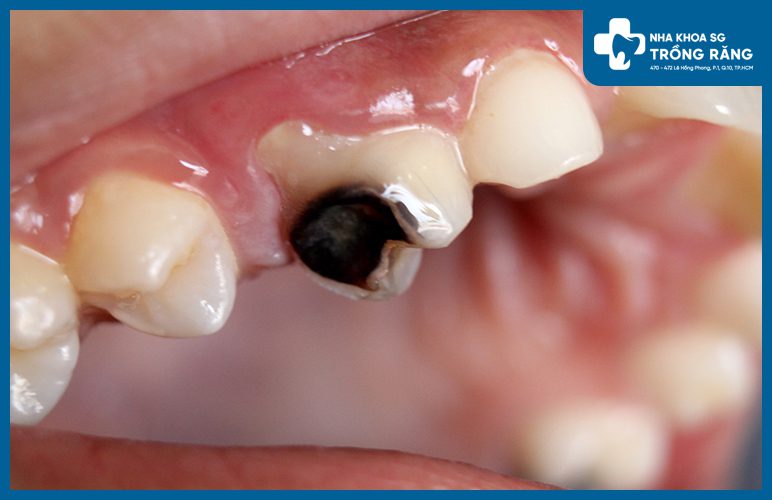 Hình ảnh răng sâu viêm tủy nặng