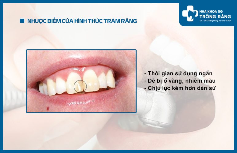 khuyết điểm trám răng cửa bị mẻ khuyết điểm trám răng cửa bị mẻ