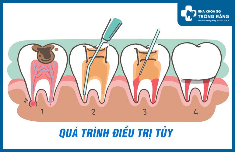 quá trình lấy tủy răng quá trình lấy tủy răng
