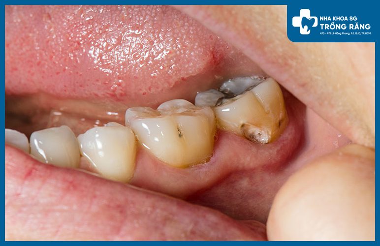 Răng nhai bị sâu viêm tủy