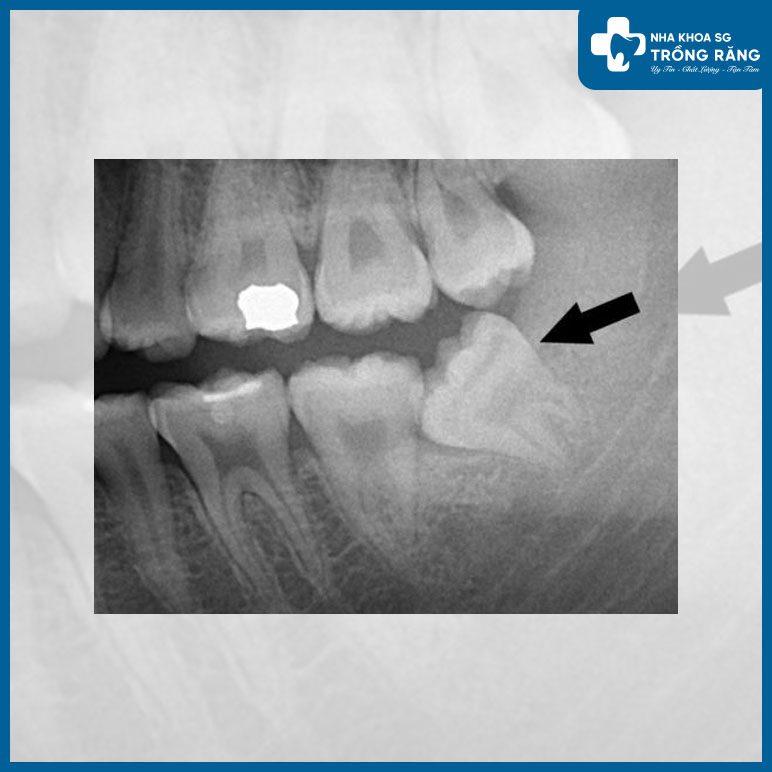 răng số 7 bị ảnh hưởng bởi răng khôn răng số 7 bị ảnh hưởng bởi răng khôn