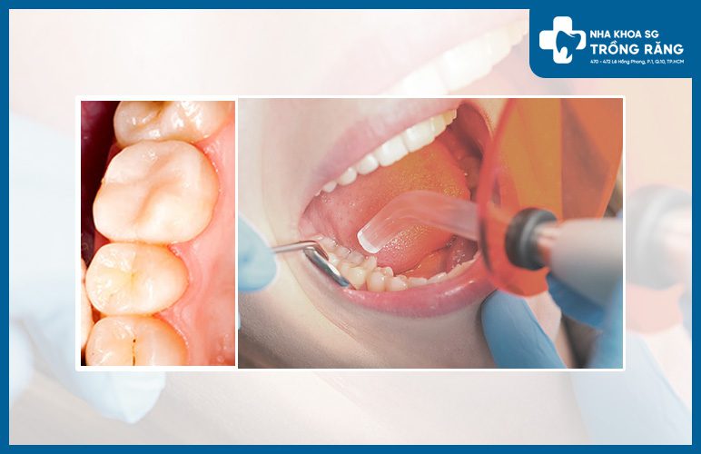 Trám răng số 7 trám răng số 7