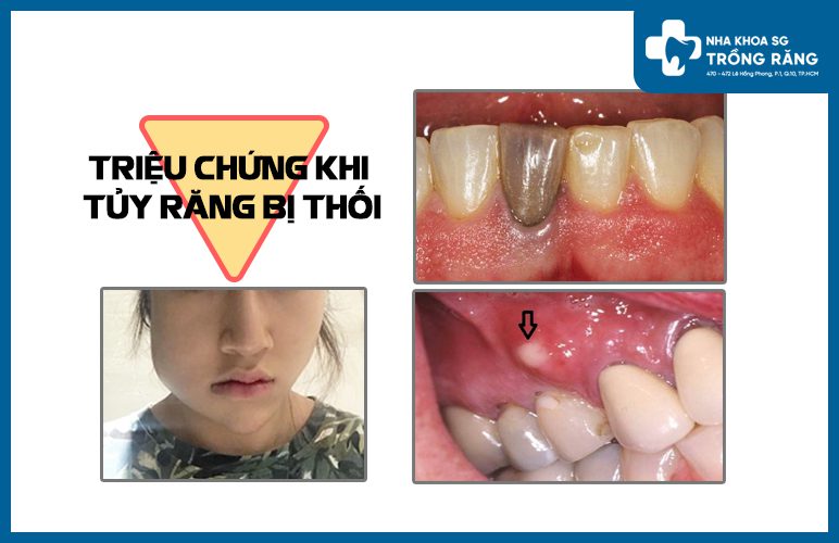 triệu chứng tủy răng bị thối triệu chứng tủy răng bị thối