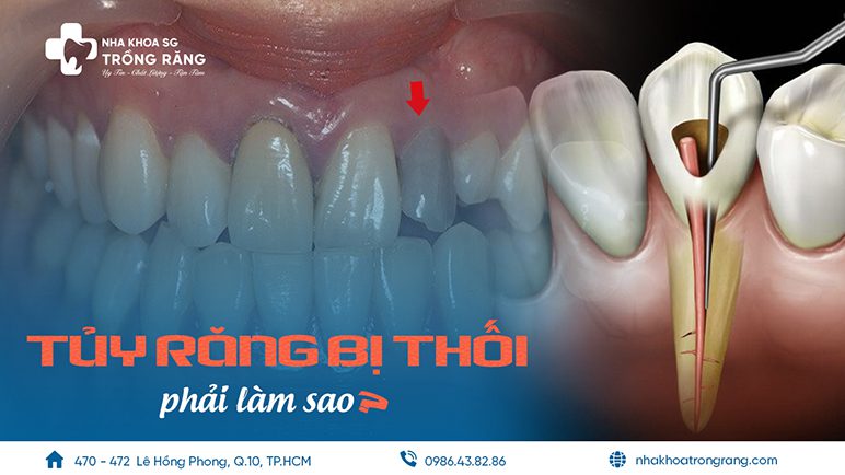 tủy răng bị thối phải làm sao tủy răng bị thối phải làm sao