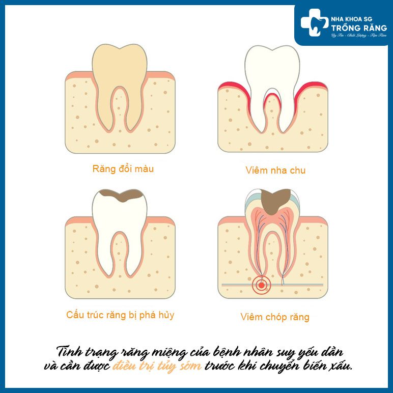 vì sao cần lấy tủy răng vì sao cần lấy tủy răng
