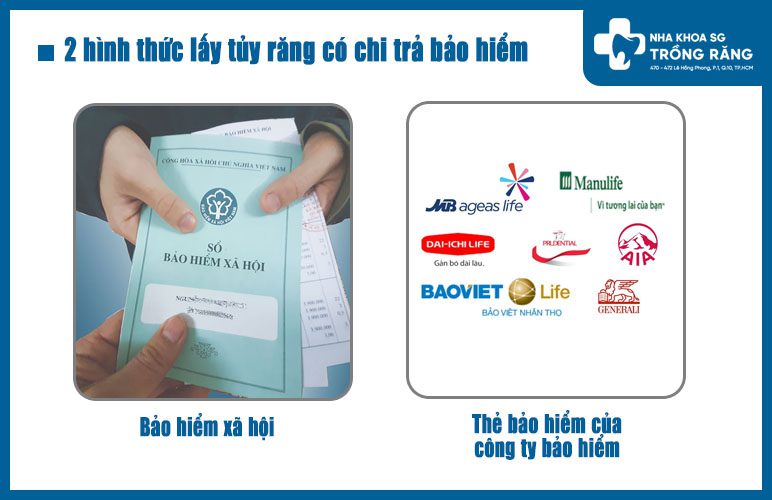Lấy tủy răng có chi trả bảo hiểm lấy tủy răng có chi trả bảo hiểm