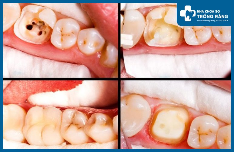 Lấy tủy răng chưa chết tủy lấy tủy răng chưa chết tủy