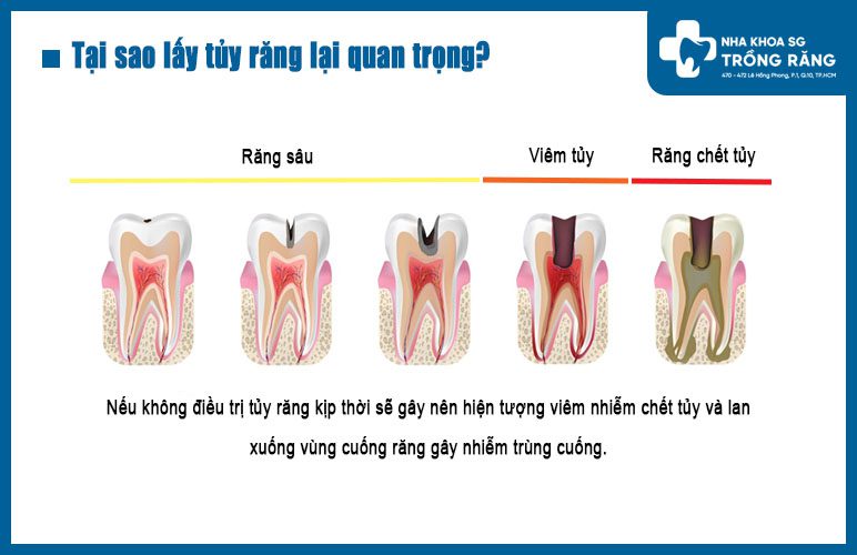 Tại sao lấy tủy răng lại quan trọng? tại sao lấy tủy răng lại quan trọng